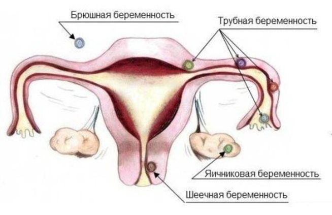 внематочная беременность.jpg внематочная беременность.jpg