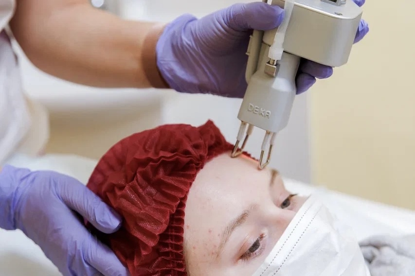 Термолифтинг лица