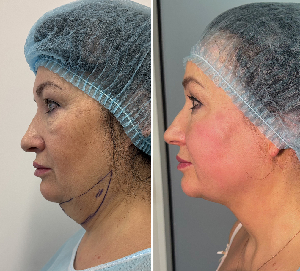 Липоредукция