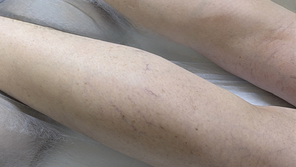 Склеротерапия вен