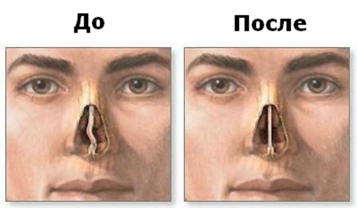Искривление носовой перегородки: причины, симптомы, лечение