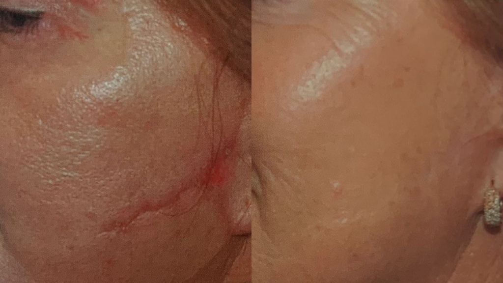 Коррекция шрамов и рубцов