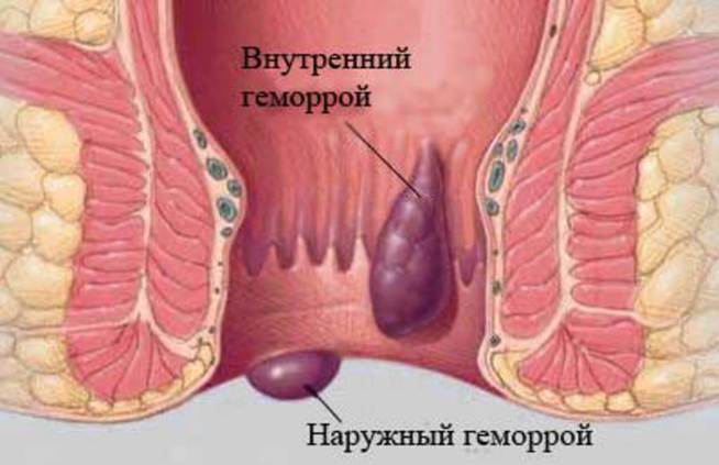 геморрой.jpg