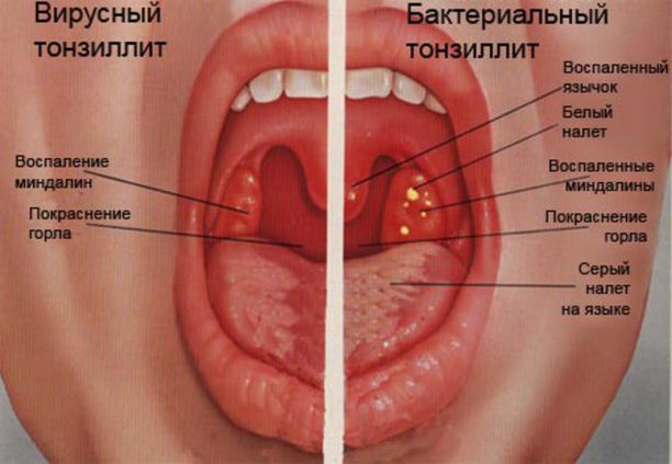 Хронический тонзиллит.jpg Хронический тонзиллит.jpg