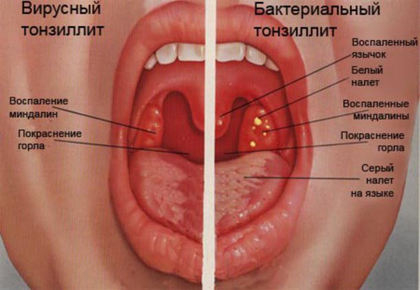 Хронический тонзиллит.jpg