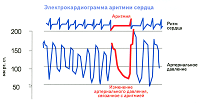 Нарушения сердечного ритма.gif