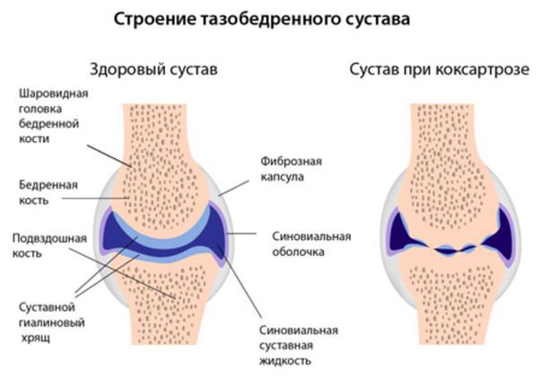 коксартроз тазобедренного сустава ГОТОВО.jpg