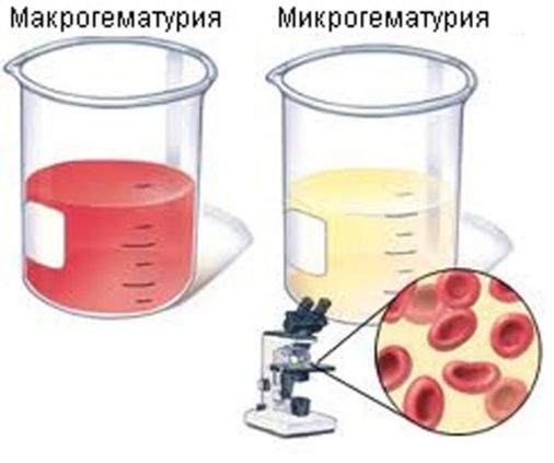 гематурия.jpg