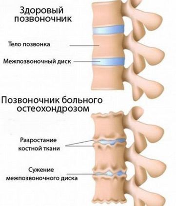 Остеохондроз позвоночника2.jpg