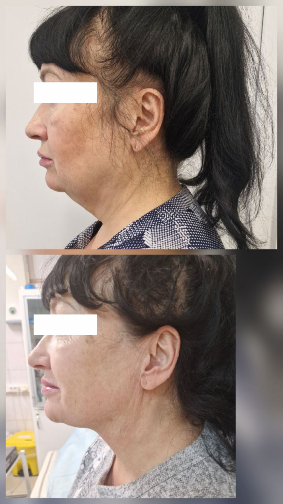 липередукция в екатеринбурге 3.png