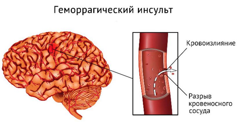 Геморрагический инсульт.jpg