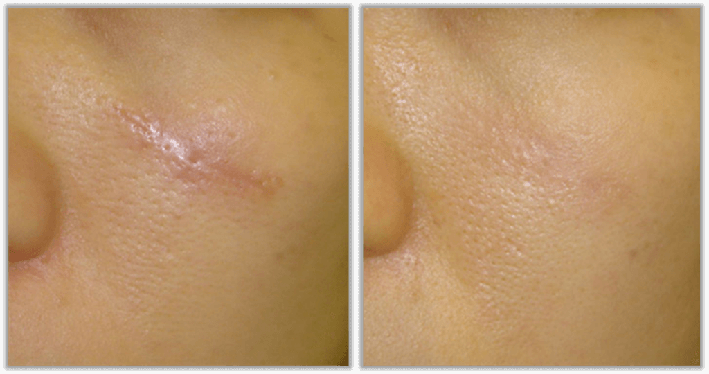 Коррекция шрамов и рубцов