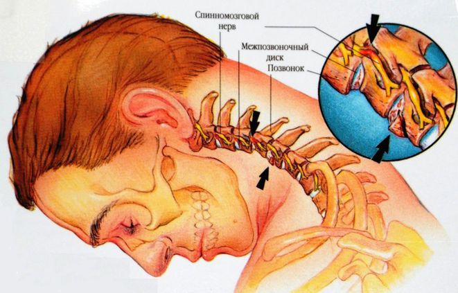 Шейный остеохондроз.jpg