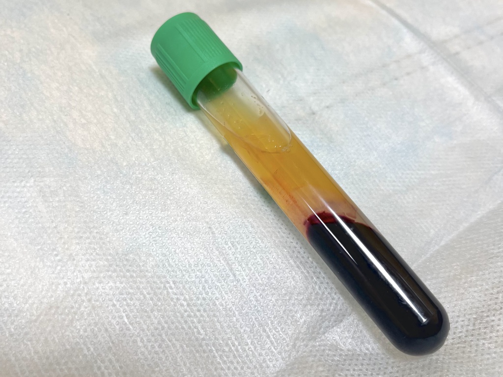 Плазмолифтинг в Екатеринбурге.jpg