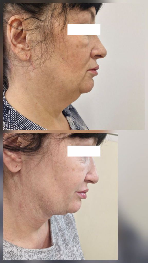 липередукция в екатеринбурге 4.png