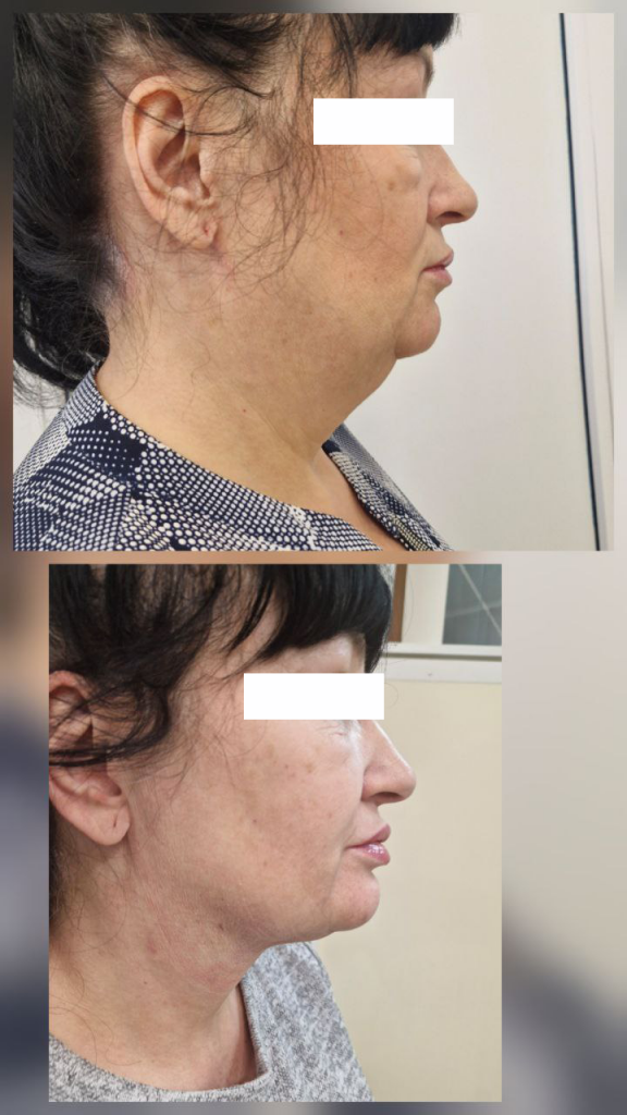 липередукция в екатеринбурге 1.png