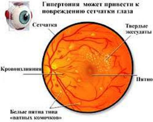 Гипертоническая ретинопатия.jpg
