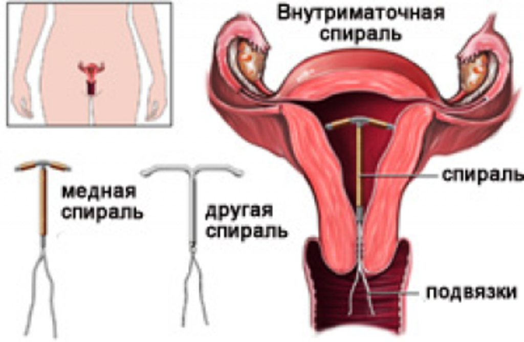 Контрацепция. Внутриматочная спираль.png