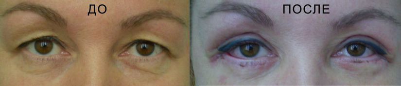 Блефаропластика в ЕМЦ_до_после.jpg