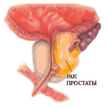 Опухолевые заболевания мужской половой сферы. Онкоурология.jpg