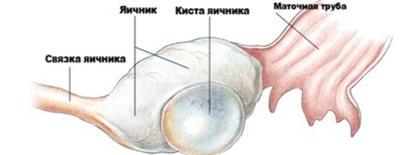 2 в яичниках образуются. Фолликулярная киста яичника клиника. Фолликула киста левого яичника. Цилиоэпителиальная киста яичника. Функционал киста левого яичника.