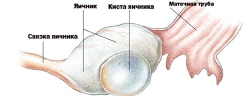 Киста 7 мм