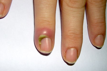 лечение панариция в Екатеринбурге.jpeg