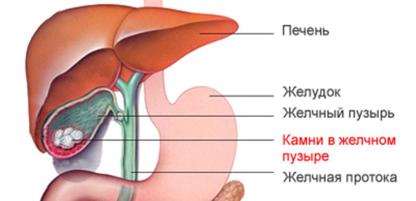 Желчекаменная болезнь.jpg