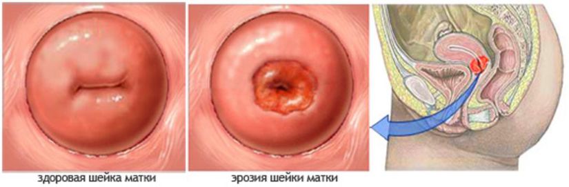 Эрозия шейки матки.jpg