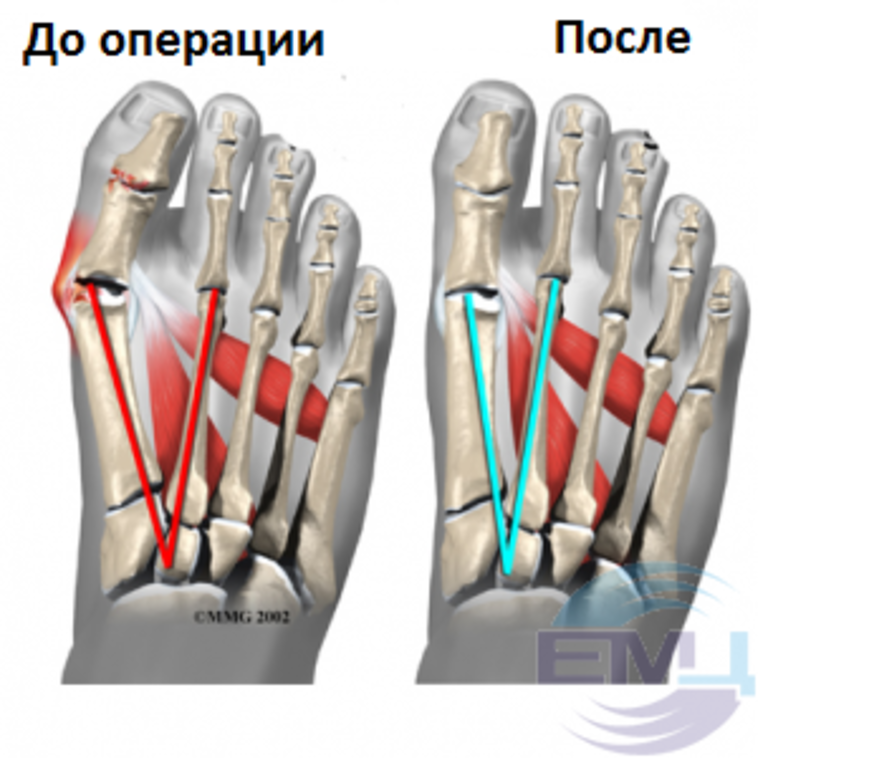 Деформация стопы.png