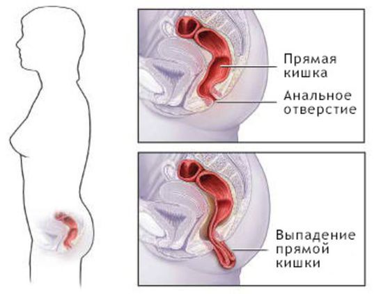 Выпадение прямой кишки.jpg