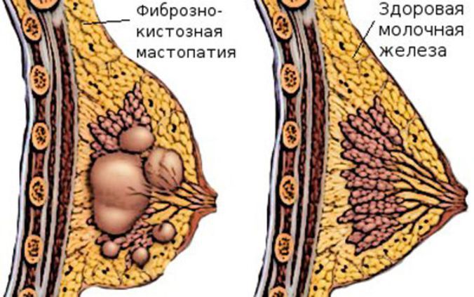 Мастопатия.jpg