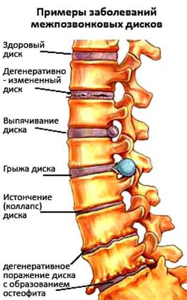 Межпозвоночная грыжа.jpg Межпозвоночная грыжа.jpg