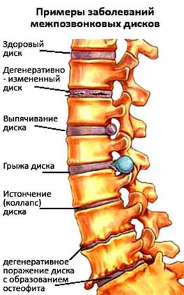 Межпозвоночная грыжа.jpg