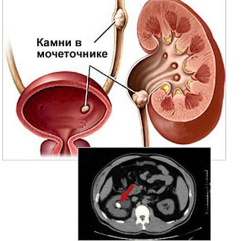 Мочекаменная болезнь.jpeg