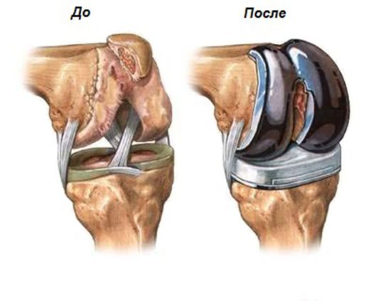 Эндопротезироание.jpg