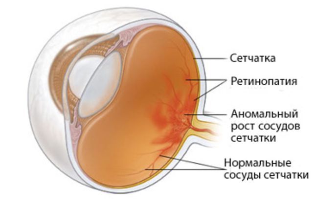 Ретинопатии.jpg Ретинопатия.jpg
