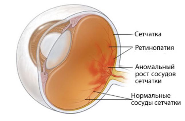 Ретинопатия.jpg