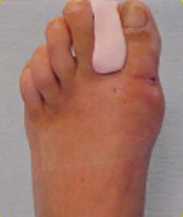 HALLUX~3.JPG