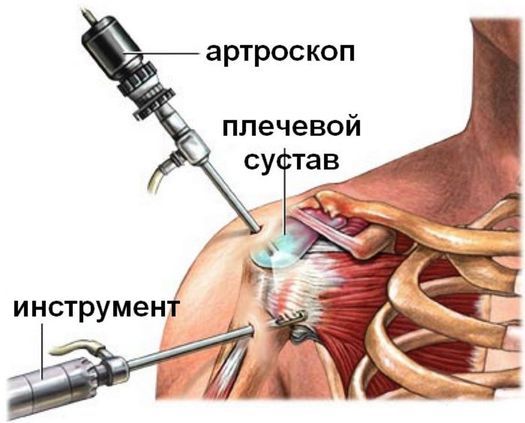 Операции на суставах. Понятие Артроскопии.jpg