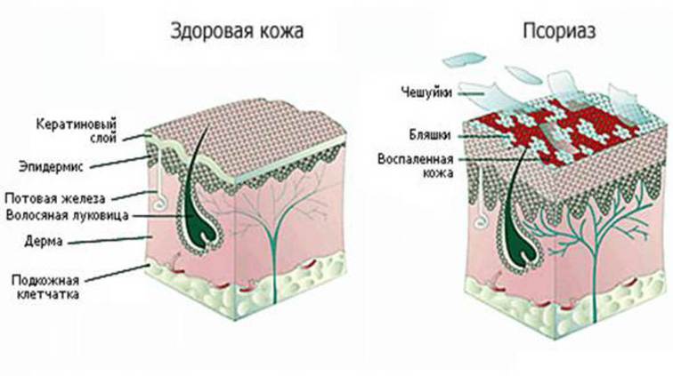 псориаз.jpg