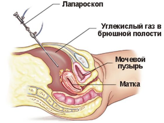 Лапароскопия и другие операции при бесплодии.jpg