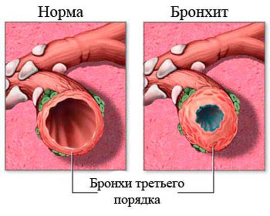 бронхит 2.jpg