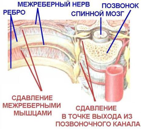 межреберная навралгия.jpg