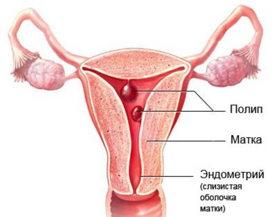 Полип эндометрия.jpg