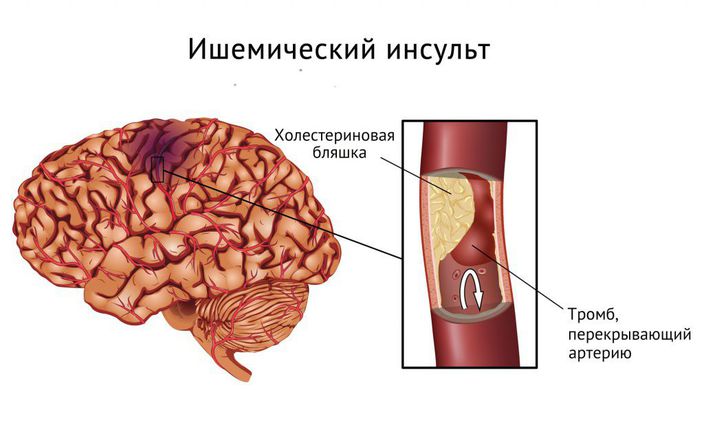 Ишемический инсульт.jpg