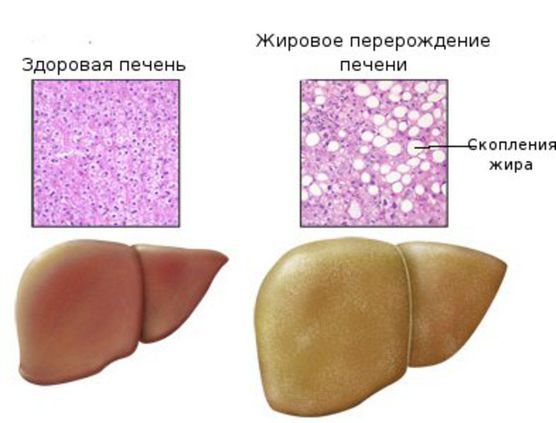 Жировой гепатоз.jpg