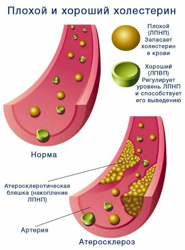 лечение нарушения липидного обмена в Екатеринбурге.jpeg
