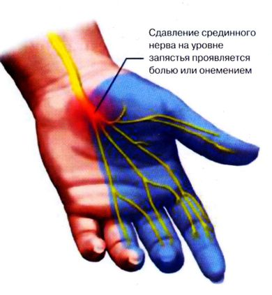 Полинейропатии2.jpg