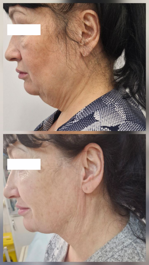 липередукция в екатеринбурге 2.png